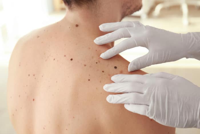 melanoma cáncer de piel