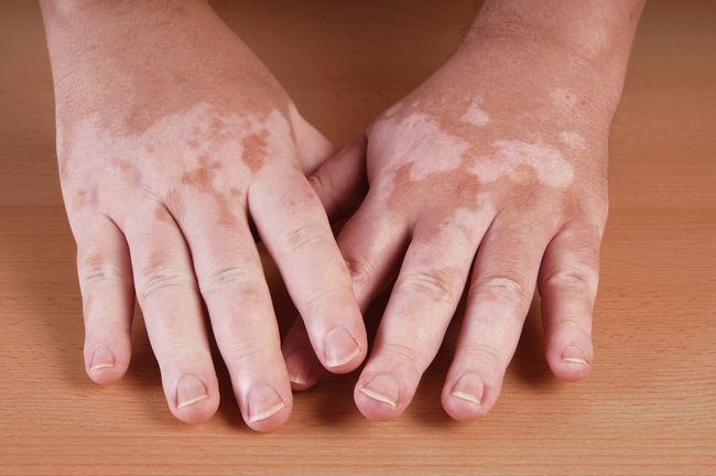 el vitiligo puede curar