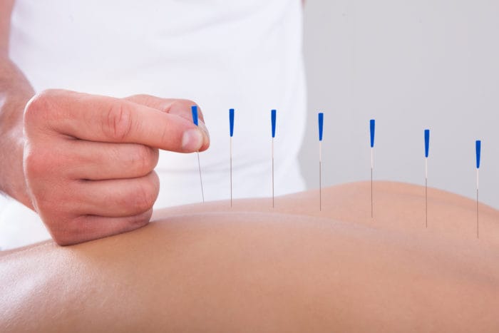 la acupuntura alivia el dolor