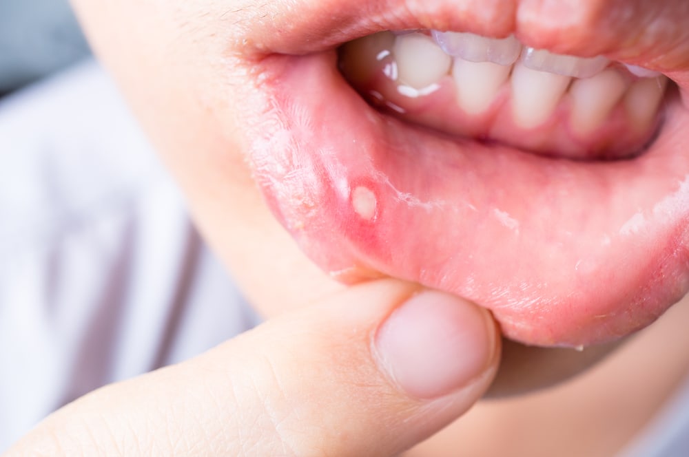 causa de úlcera en la boca