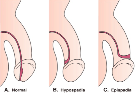 El orificio del pene no es normal, episodios de hipospadias.