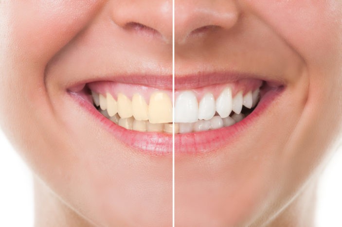 Efectos secundarios del blanqueamiento dental con blanqueamiento.