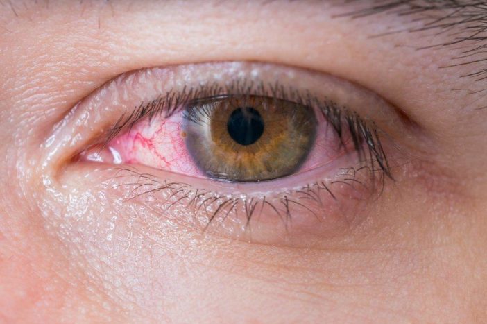 conjuntivitis alérgica de ojo rojo