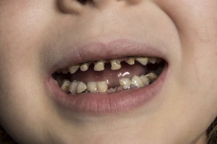 Biberón caries dental por caries infantil