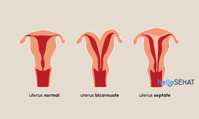 anomalías en el útero