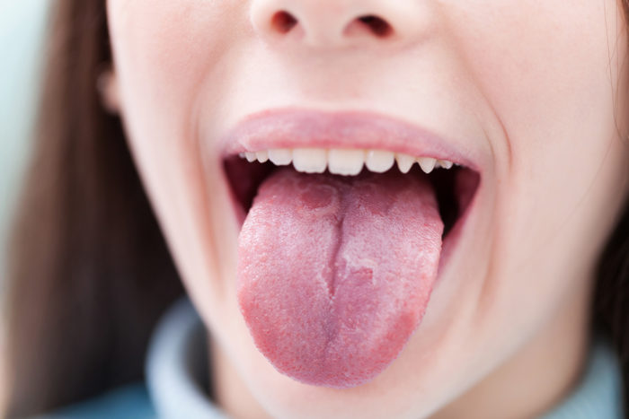 psoriasis de la lengua
