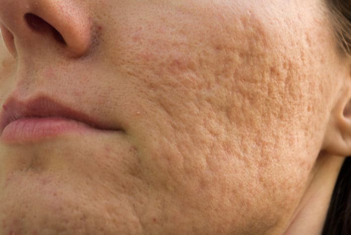 cómo deshacerse de las cicatrices del acné pockmark