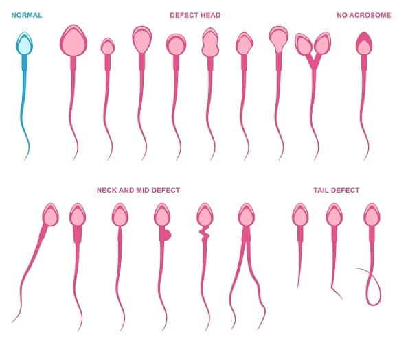 anomalías de esperma
