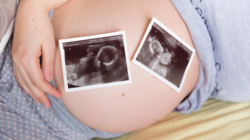 El riesgo de quedar embarazada de gemelos desaparece.
